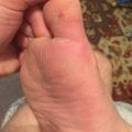 Лично мне помог от шипицы