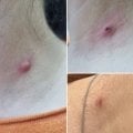 Долгие годы меня беспокоила неприятная бородавка