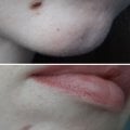 Как я избавилась от неприятностей на лице